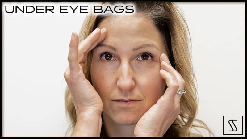 Under Eye Bags