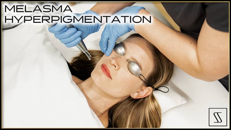 Melasma Hyperpigmentation