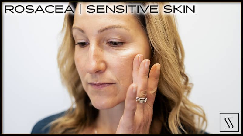 Rosacea | Sensitive Skin